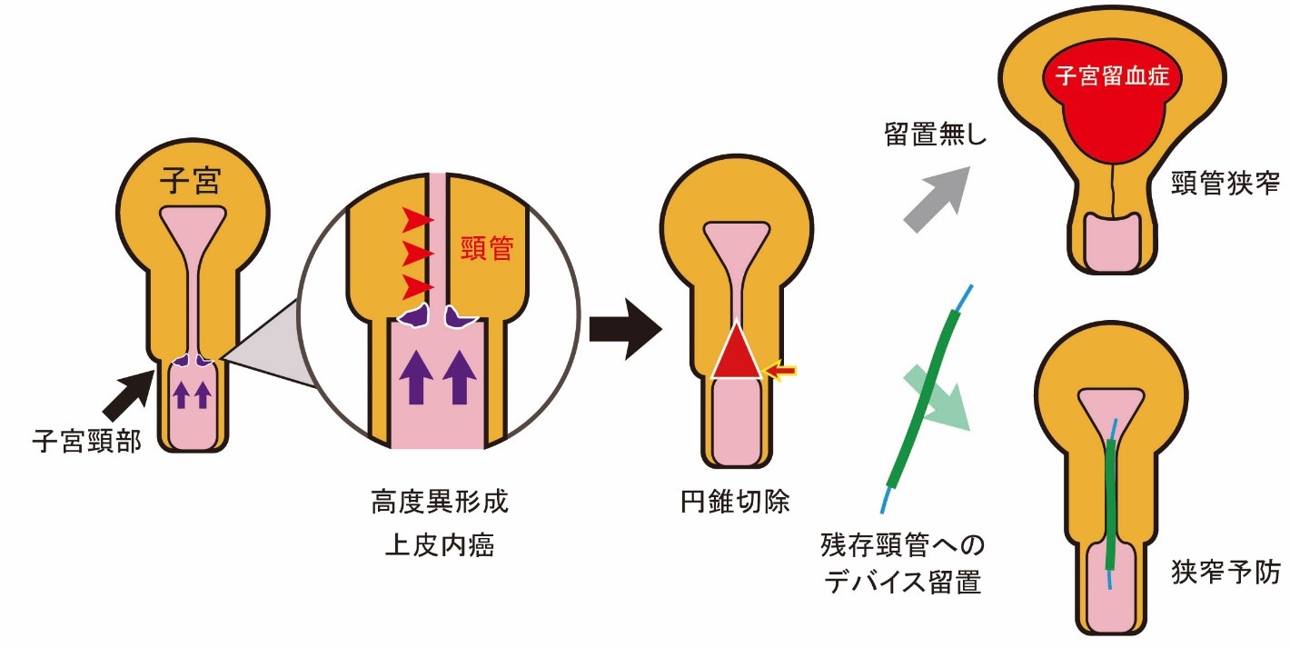 円錐 切除 術