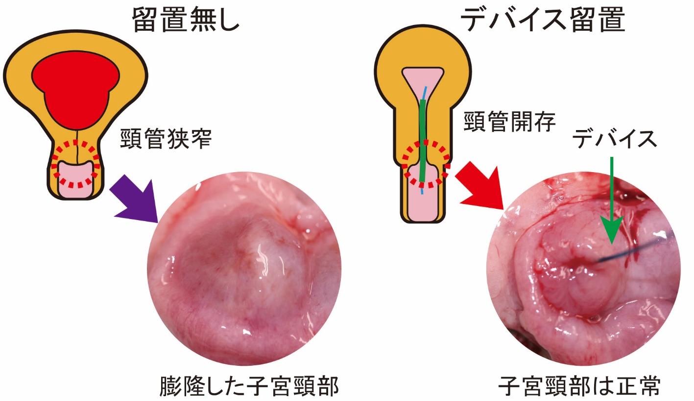 切除 術 円錐 円錐切除術後4週間診察